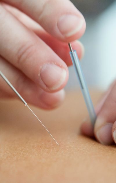 Acupuncture